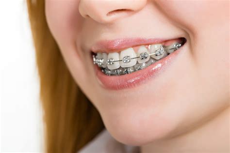 fotos brackets metalicos|precio de bracket dental.